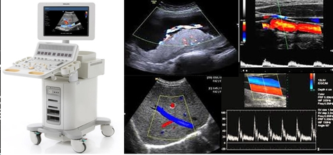 Ultrasound of Breast – Beacon Health Screening Centre