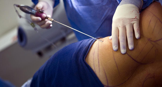 Laser liposuction treatment