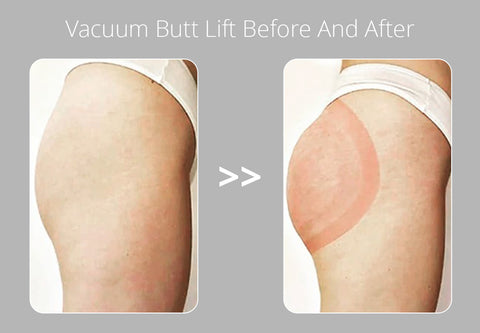 Vacuum Butt Lift Before And After