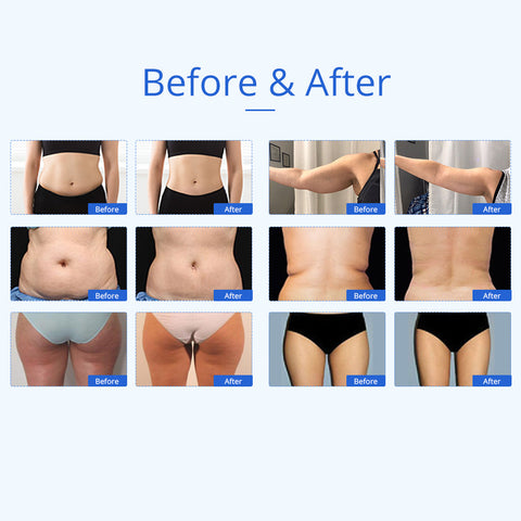 Unoisetion 6 in 1 40K Laser Lipo Cavitation Machine Before and After