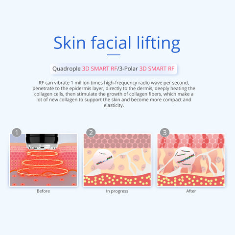 Radio frequency facial skin lifting and tightening