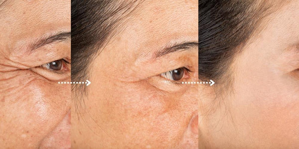 chemical peels results and before after