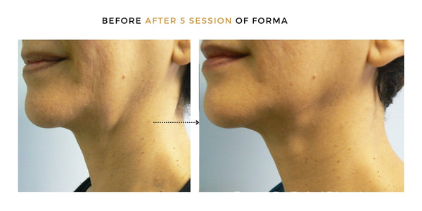 forma facial before after results