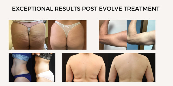 Evolve results and before after
