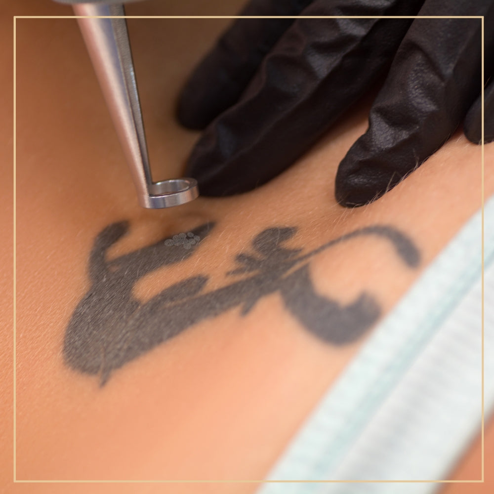 permanent tattoo removal 