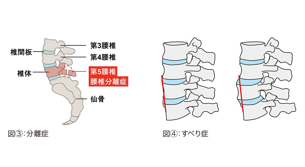 分離症・すべり症