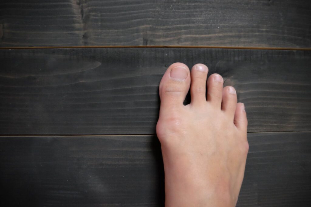 How to Choose the Best Bunion Shoe for Bunion Relief