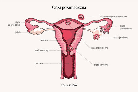 Ilustracja ciąży pozamacicznej