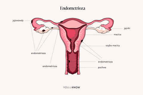 Ilustracja endometrioza