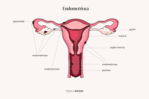Ilustracja endometriozy