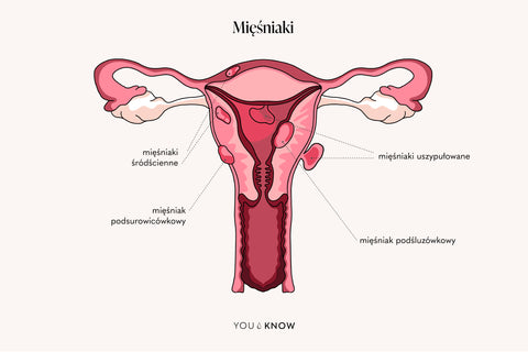 Ilustracja mięśniaki macicy