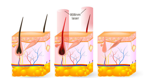 808nm diode laser hair removal