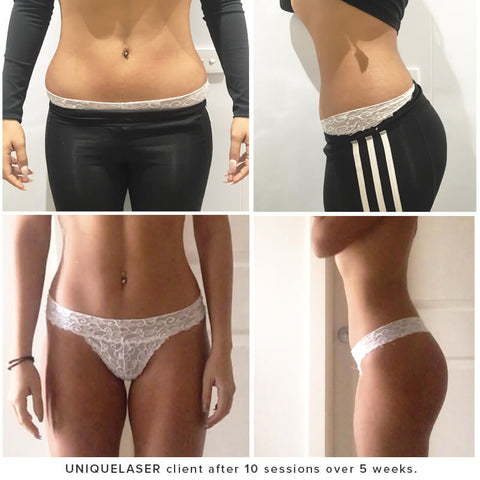 Fat Loss Cavitation before after