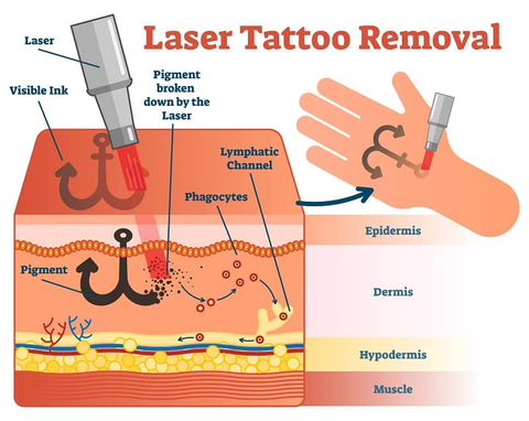 Tattoo removal