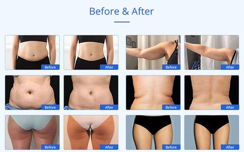 lipo laser