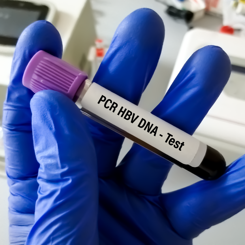 hbv-dna-pcr-quantitative-essa-laboratory-essalaboratory