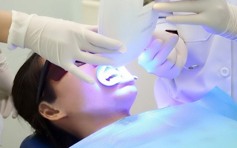 Does teeth whitening work?