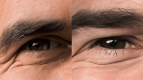 GreyAway Eyebrow Before & After