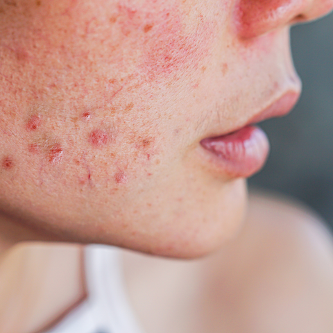  symptoms of contact dermatitis vary widely and may include: An itchy rash. Leathery patches that are darker than usual (hyperpigmented), typically on brown or Black skin. Dry, cracked, scaly skin, typically on white skin. Bumps and blisters, sometimes with oozing and crusting. Swelling, burning or tenderness.