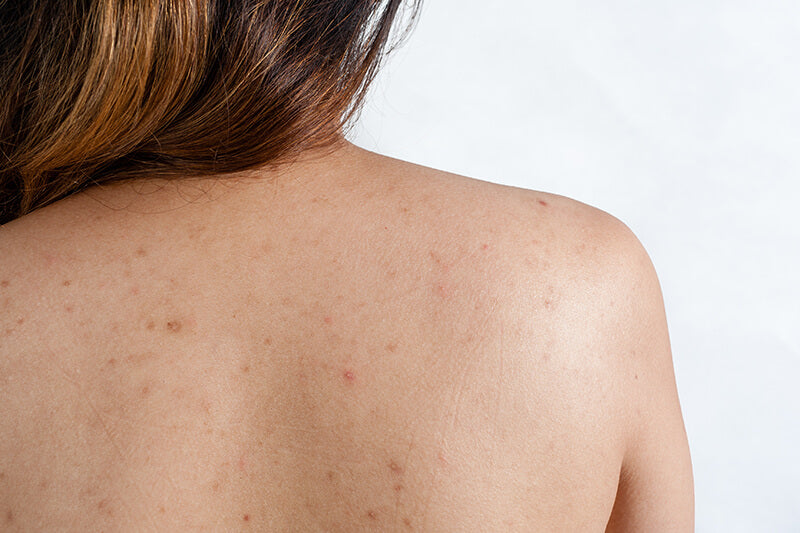 Acne Scar On A Woman's Back