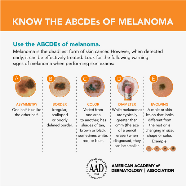 ABCDE of melanoma