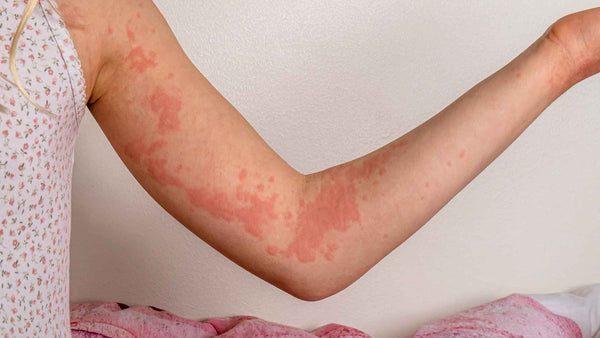 A girl with hives on her arm.