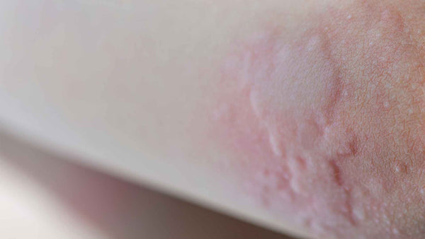 A close up of a person's arm with stress hives.