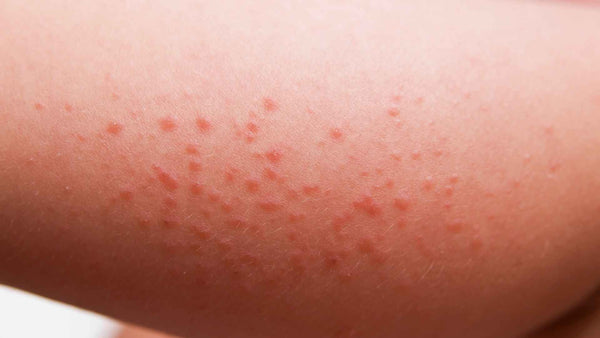 A close up of a child's arm with a rash of small red spots.