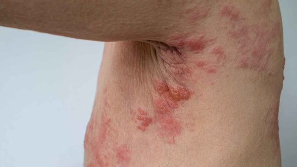 Shingles on a person's chest.