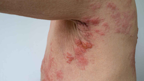 Hives vs Rash: How to Tell The Difference – Dermeleve®