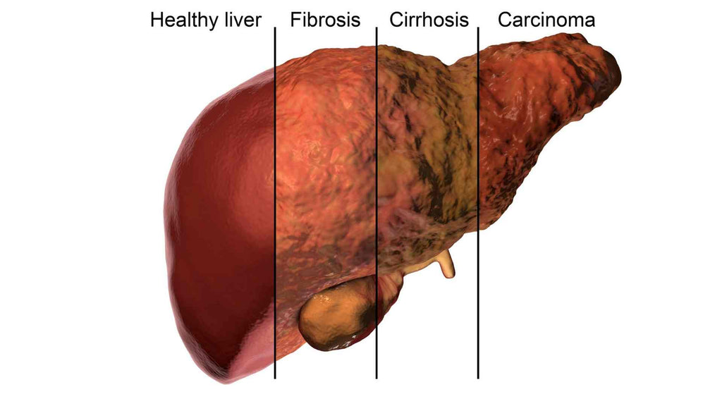 Visual of different types of liver disease, including Cirrhosis