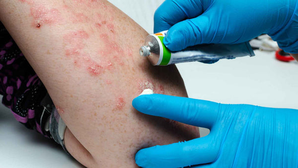 Un médico está aplicando una crema al brazo de una persona para tratar una erupción.