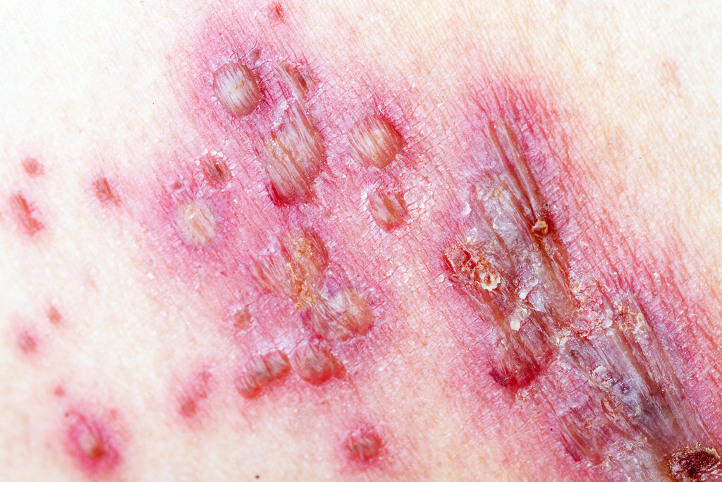 shingles blisters