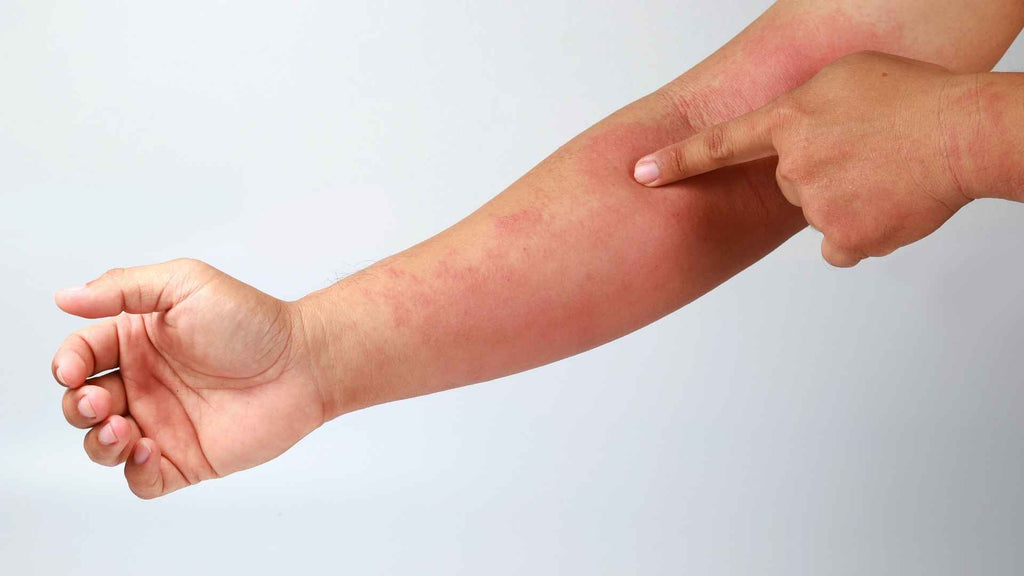 A man pointing to an outbreak of eczema on his arm.