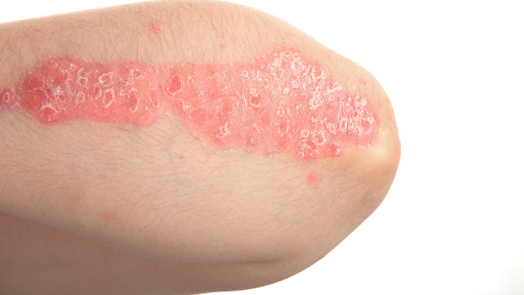 Psoriasis on an elbow