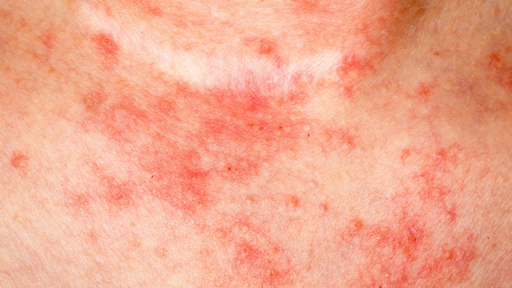 Itchy red bumps on skin