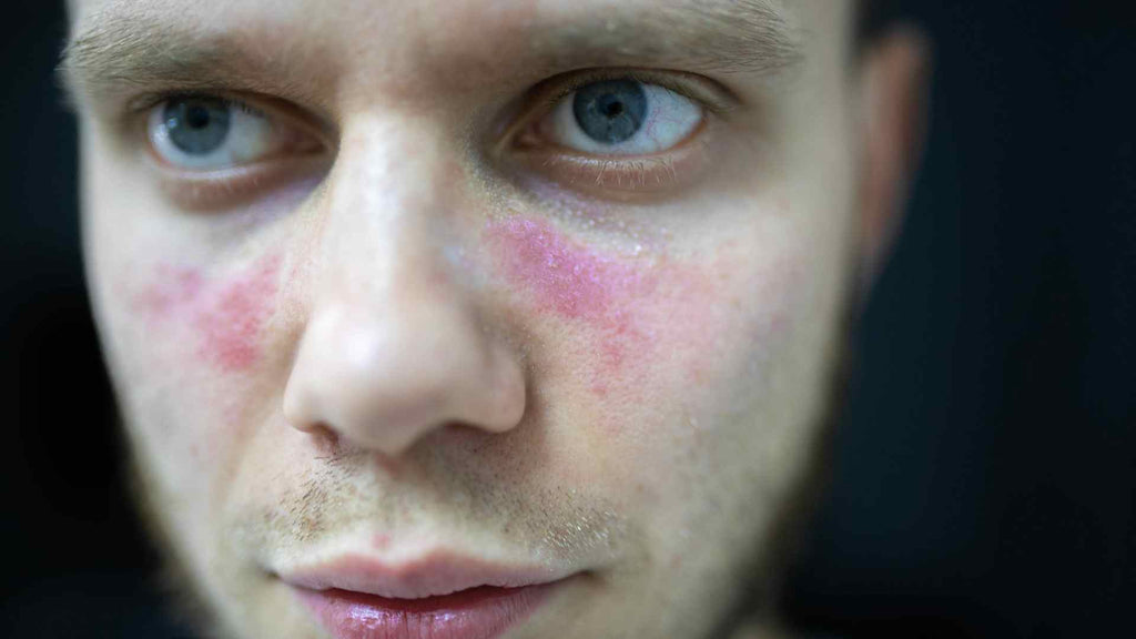 Close-up of lupus malar rash on cheeks and nose