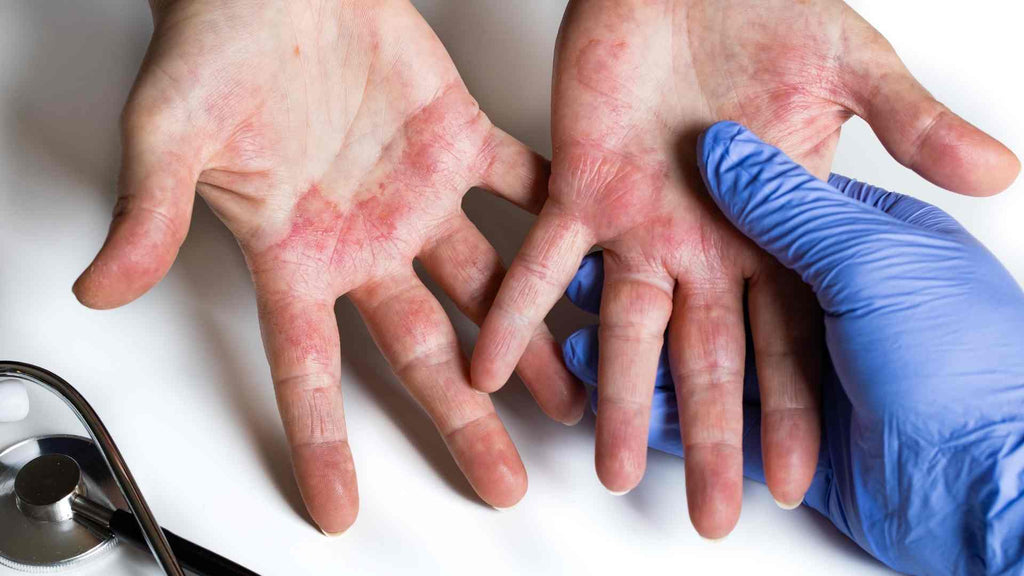 Eczema of the hand