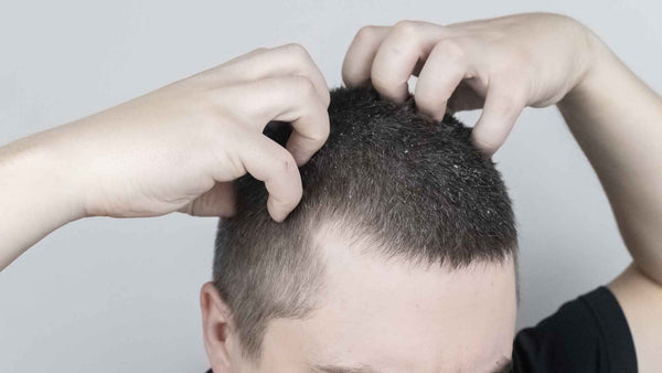 Un hombre calma su picazón en el cuero cabelludo al peinar su cabello con las manos.
