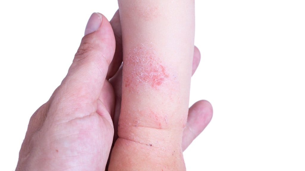 Eczema on a young child's arm