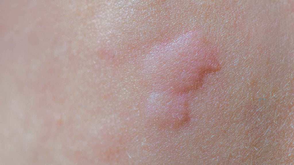 A close-up of a person's skin with hives.