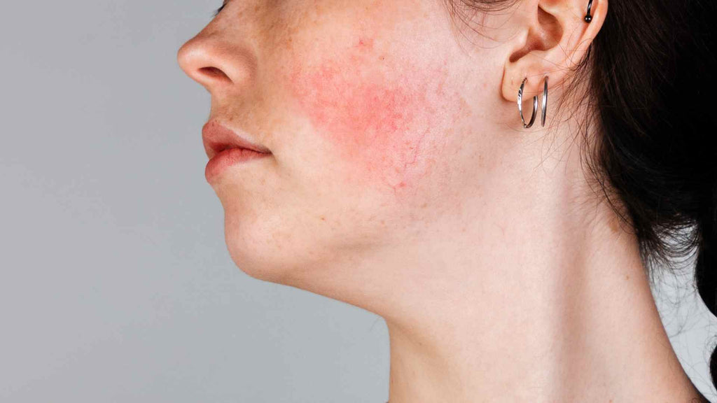 Close-up of a woman's face with rosacea symptoms