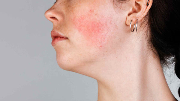 Primer plano de la cara de una mujer con síntomas de rosácea