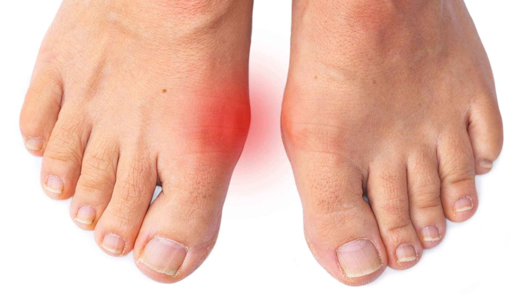 Foot eczema