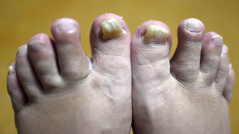 Fungus on the toe nails