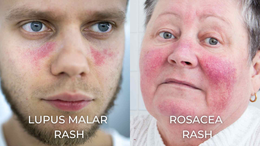 Side-by-side comparison of lupus malar rash and rosacea rash
