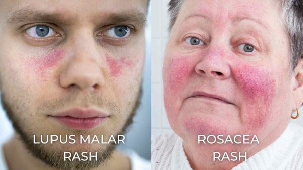 Comparación de lado a lado de lupus erupción malar y erupción de rosácea