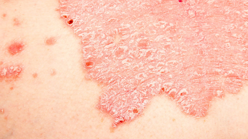 Closeup of psoriasis flakes