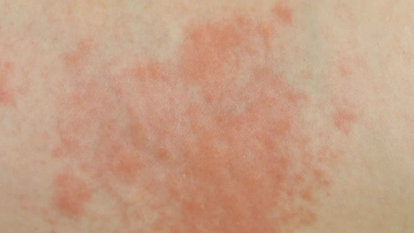 Un primer plano de la piel de una persona con una erupción roja.