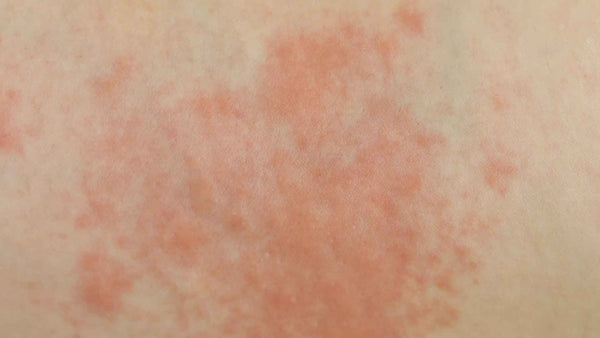 Hives vs. rash: Pictures, differences, and symptoms